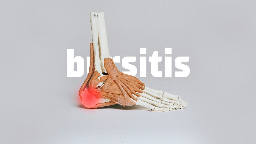 Bursitis